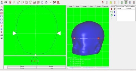 modello 3D e plagiocefalometria