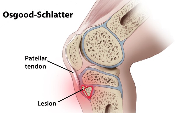 Osgood-Shlatter: anatomia