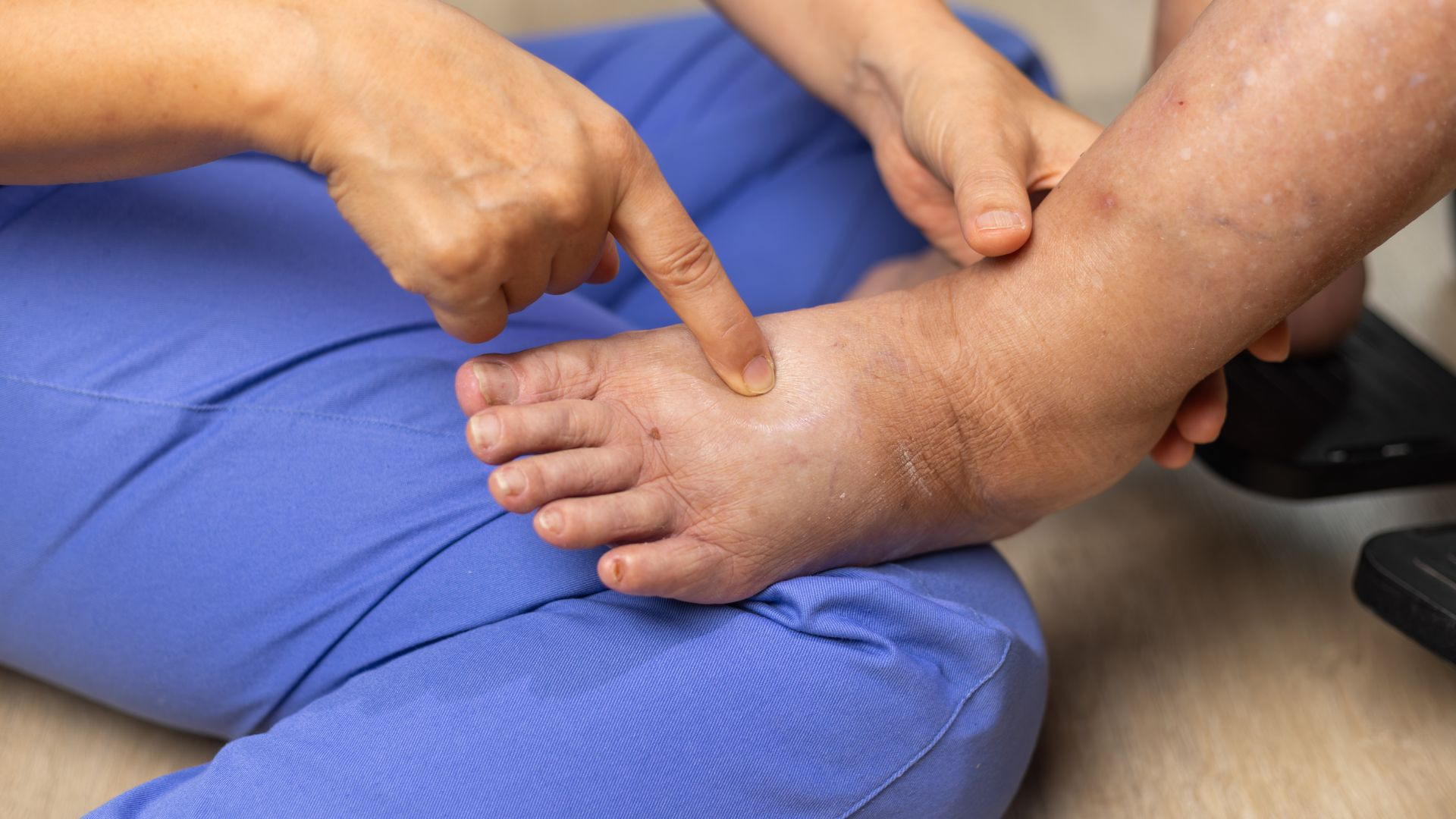 Il piede diabetico: come proteggerlo ogni giorno con cura e la scarpa giusta